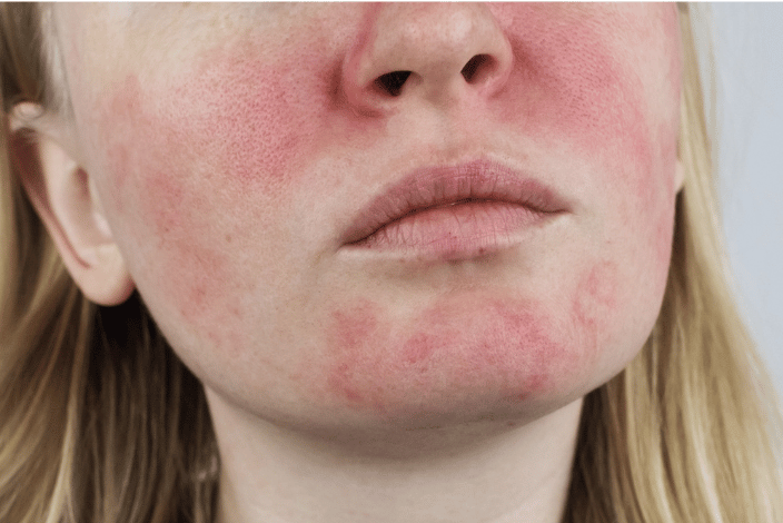 problemova, akneozna pokozka, ekzem, rosacea, sucha a citliva pokozka (2)